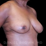 Fat Transfer Before & After Patient #9964