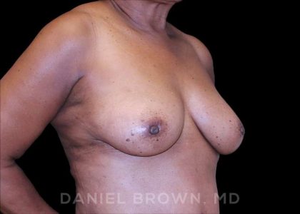 Fat Transfer Before & After Patient #9964