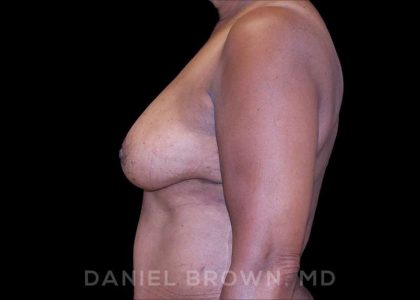 Fat Transfer Before & After Patient #9964