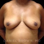 Fat Transfer Before & After Patient #9964