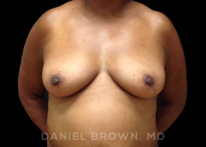 Fat Transfer Before & After Patient #9964