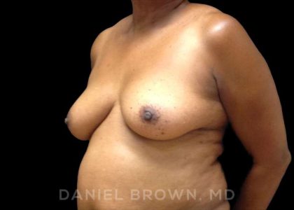 Fat Transfer Before & After Patient #9964