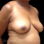Fat Transfer Before & After Patient #9964