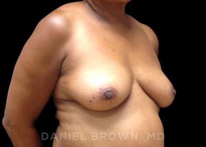 Fat Transfer Before & After Patient #9964