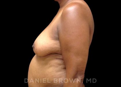 Fat Transfer Before & After Patient #9964