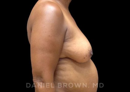 Fat Transfer Before & After Patient #9964