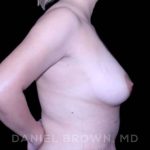 Fat Transfer Before & After Patient #9975