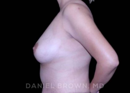Fat Transfer Before & After Patient #9975