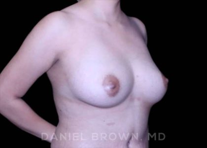 Fat Transfer Before & After Patient #9975