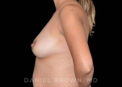 Fat Transfer Before & After Patient #9975