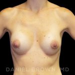 Breast Augmentation Before & After Patient #8815