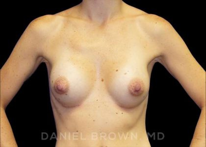 Breast Augmentation Before & After Patient #8815