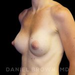 Breast Augmentation Before & After Patient #8815