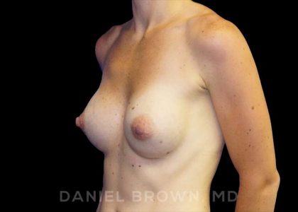 Breast Augmentation Before & After Patient #8815