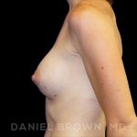 Breast Augmentation Before & After Patient #8815