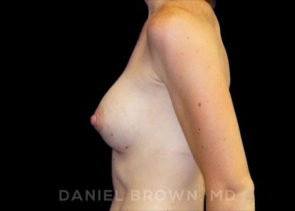 Breast Augmentation Before & After Patient #8815