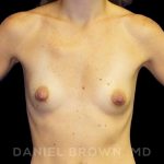 Breast Augmentation Before & After Patient #8815