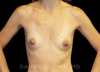 Breast Augmentation Before & After Patient #8815