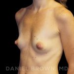 Breast Augmentation Before & After Patient #8815