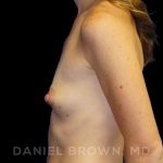 Breast Augmentation Before & After Patient #8815