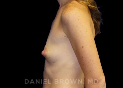 Breast Augmentation Before & After Patient #8815