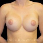 Breast Augmentation Before & After Patient #8822