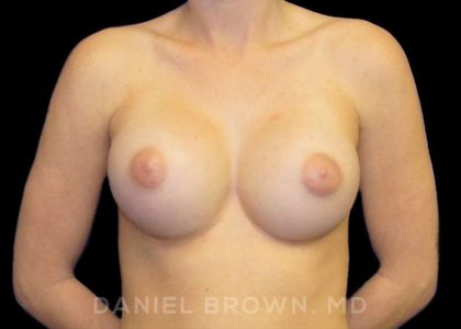 Breast Augmentation Before & After Patient #8822