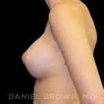Breast Augmentation Before & After Patient #8822