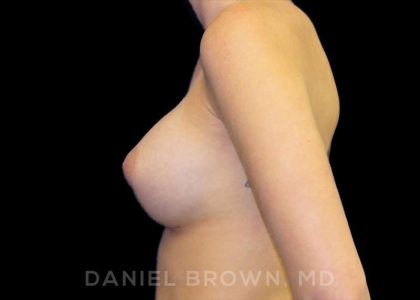 Breast Augmentation Before & After Patient #8822