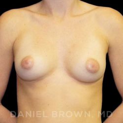 Breast Augmentation Before & After Patient #8822