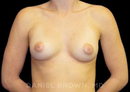 Breast Augmentation Before & After Patient #8822
