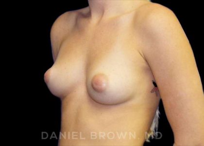 Breast Augmentation Before & After Patient #8822