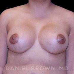Breast Augmentation Before & After Patient #8829