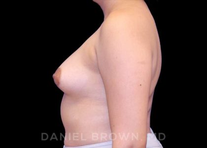 Breast Augmentation Before & After Patient #8829