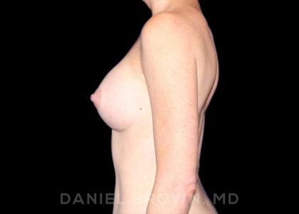 Breast Augmentation Before & After Patient #8836
