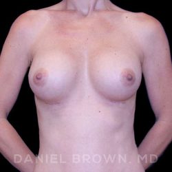Breast Augmentation Before & After Patient #8843