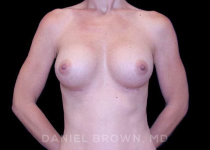 Breast Augmentation Before & After Patient #8843