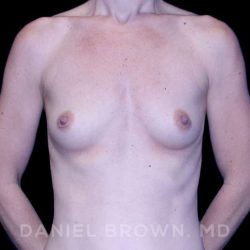 Breast Augmentation Before & After Patient #8843
