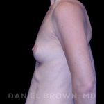 Breast Augmentation Before & After Patient #8843
