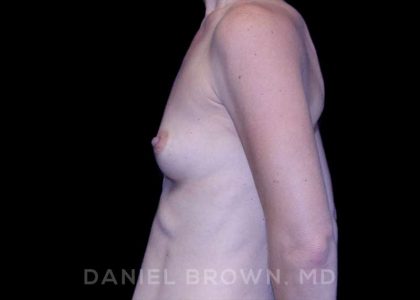 Breast Augmentation Before & After Patient #8843