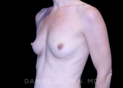 Breast Augmentation Before & After Patient #8843