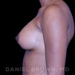 Breast Augmentation Before & After Patient #8850