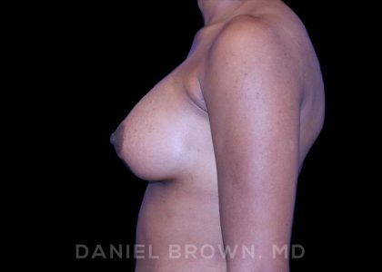 Breast Augmentation Before & After Patient #8850