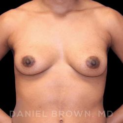 Breast Augmentation Before & After Patient #8850