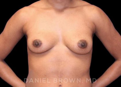 Breast Augmentation Before & After Patient #8850