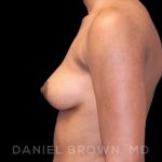 Breast Augmentation Before & After Patient #8850
