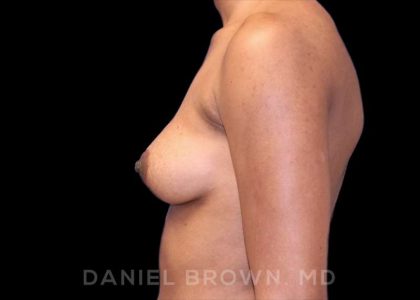 Breast Augmentation Before & After Patient #8850