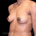 Breast Augmentation Before & After Patient #8850