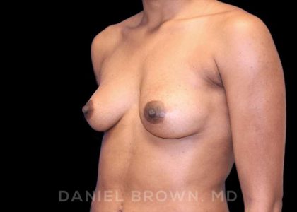 Breast Augmentation Before & After Patient #8850