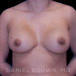 Breast Augmentation Before & After Patient #8863